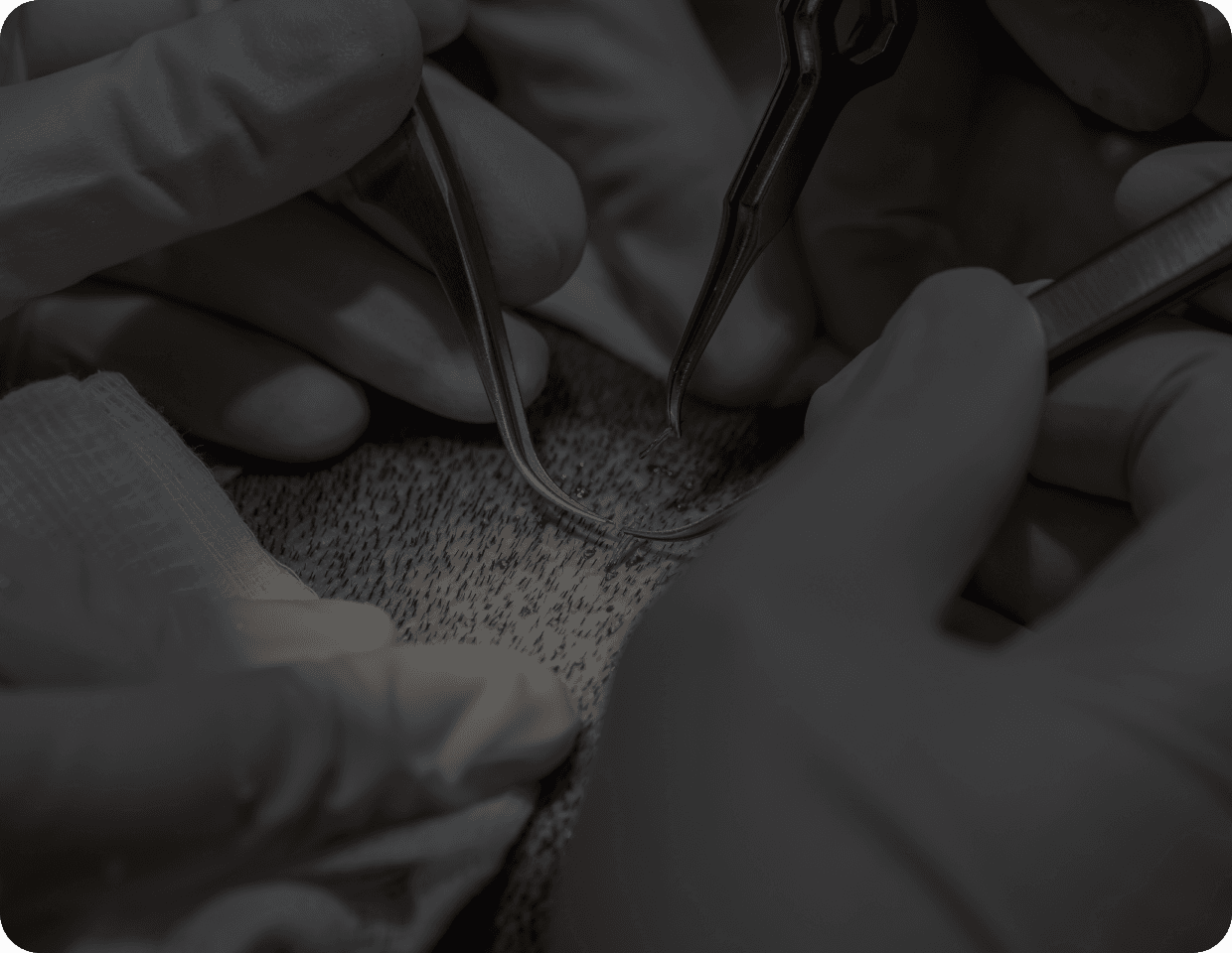 Slim Fue Hair Transplant